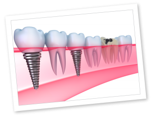 What are Dental Implants?